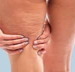 Celulitis: por qué aparece y qué tratamientos médicos pueden mejorarla, según expertos